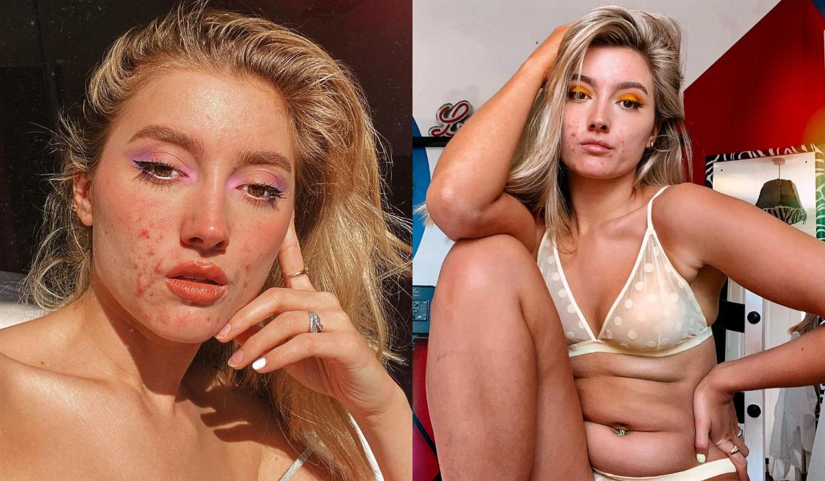 Modelka z trądzikiem reklamuje popularną markę odzieżową